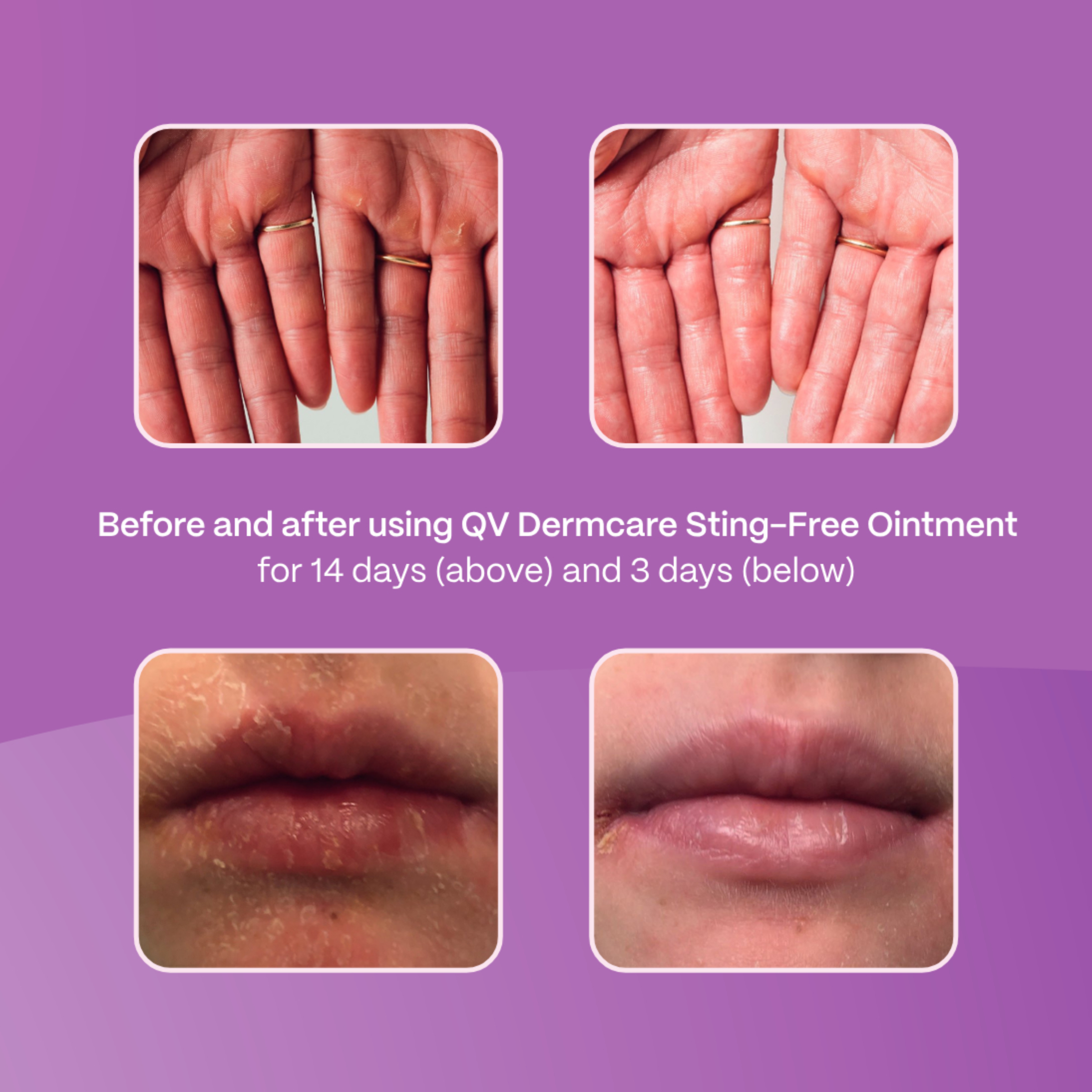 EGO QV DERMCARE STING FREE OINTMENT 200G - Image 5